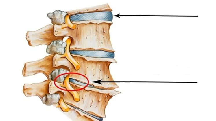 leziuni ale coloanei vertebrale în caz de osteocondroză cervicală