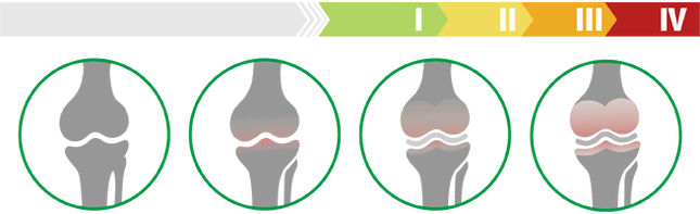 Etape clinice ale artrozei articulației genunchiului (grad de artroză a articulației genunchiului)