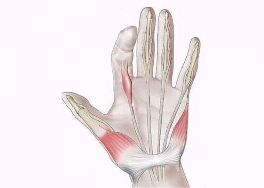 inflamația tendoanelor ca o cauză a durerii în articulațiile degetelor