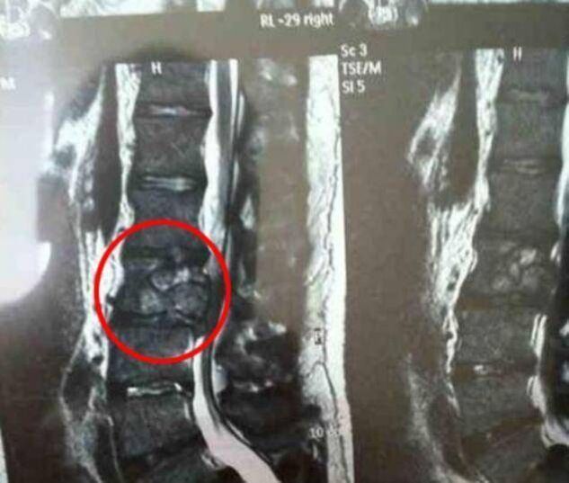Tumoarea coloanei vertebrale ca cauză a durerilor de spate