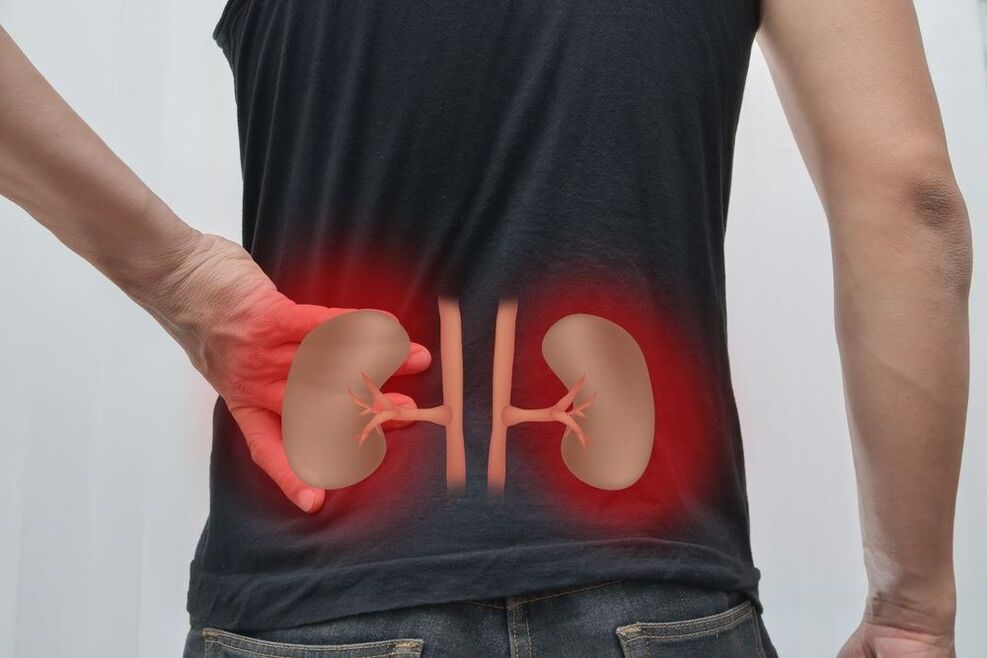 inflamația rinichilor ca cauză a durerilor de spate
