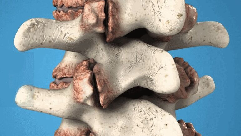 osteofite ale coloanei vertebrale ca o cauză a durerilor de spate