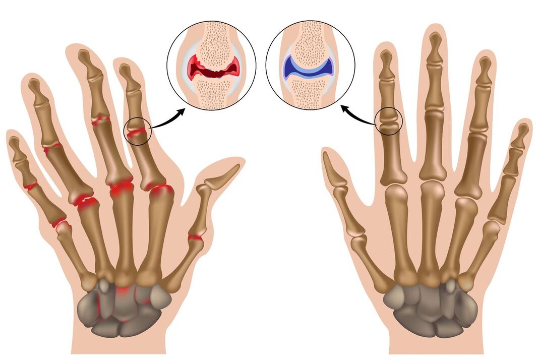 Articulațiile mâinilor sănătoase și afectate de poliartrită