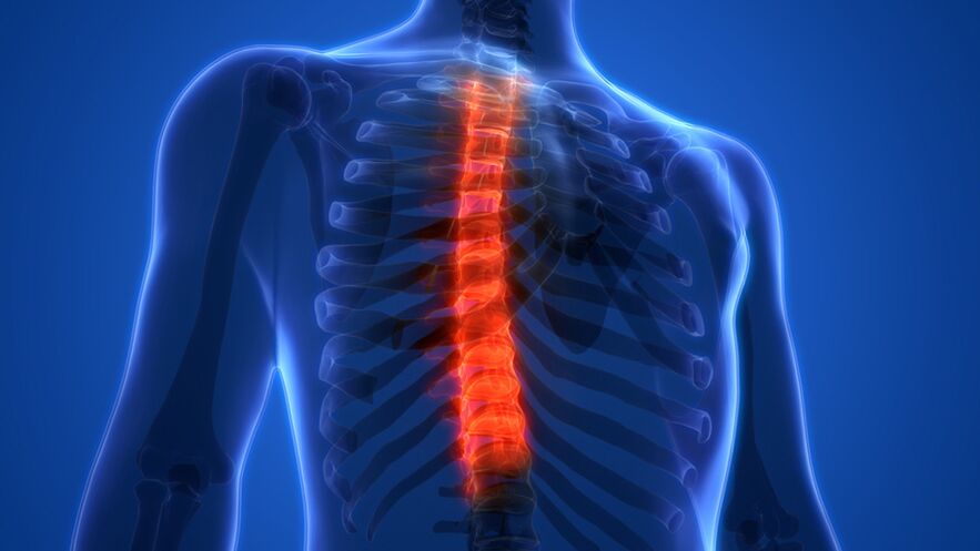 Osteocondroza coloanei vertebrale toracice, caracterizată prin distrugerea discurilor intervertebrale