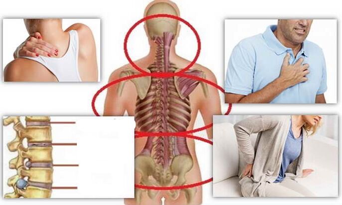 Locuri de boală pentru osteochondroză