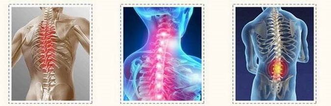Osteochondroză Leziuni ale coloanei vertebrale