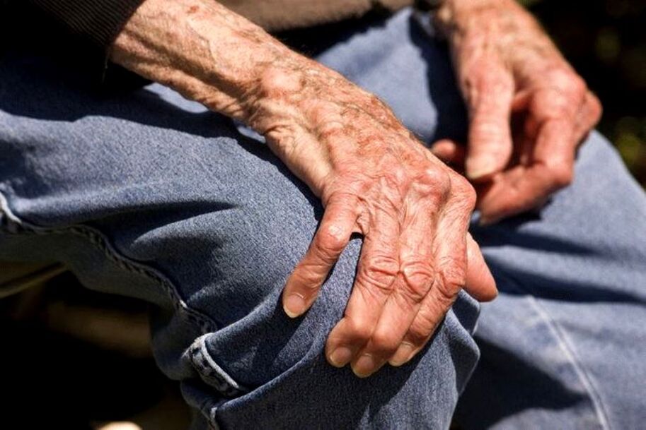 Artroza este o boală legată de vârstă, care apare la persoanele în vârstă