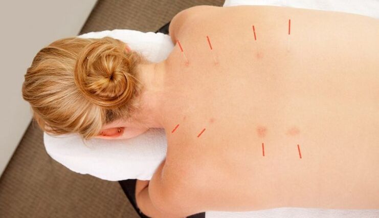 Acupunctura pentru osteocondroza toracică, care are multe avantaje